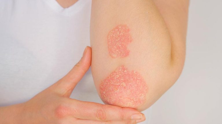 perbedaan ruam hiv dan ruam biasa
