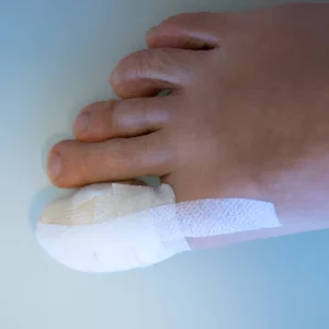 luka jempol kaki diabetes