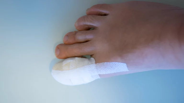 luka jempol kaki diabetes