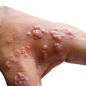 Obat herpes HIV